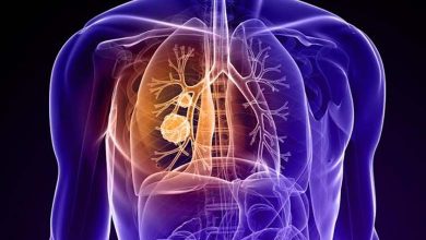A promising technology for early detection of lung cancer