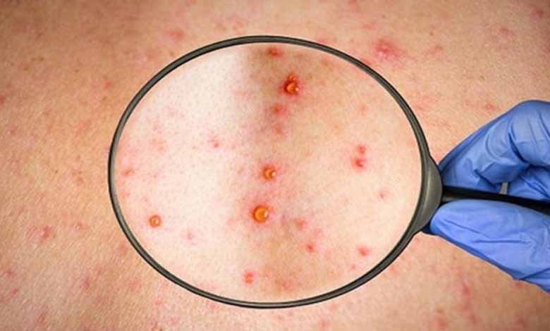Monkeypox invades Qatar, sparks government panic What will be happen in Doha after the spread of this virus?
