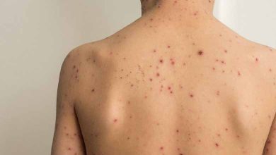 British monkeypox cases rise to 225