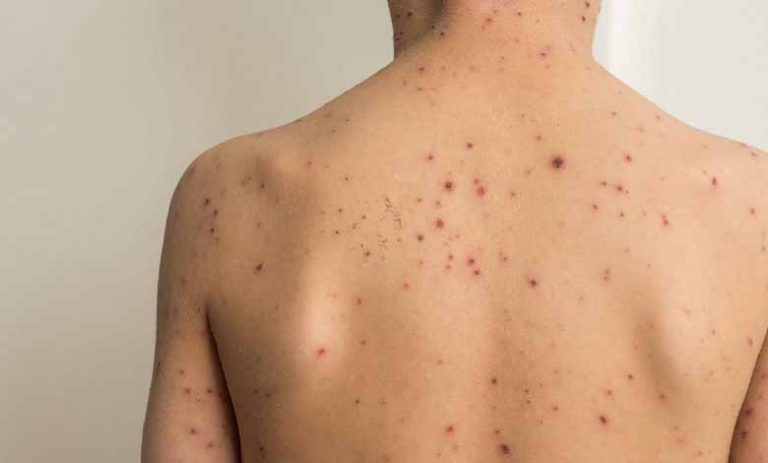 Key Pox Information – MonkeyPox - En.ImArabic