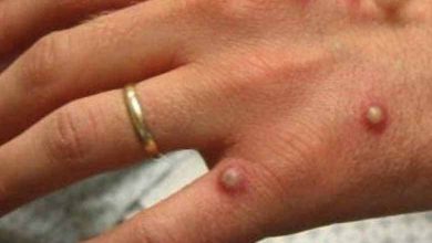 Monkeypox - 1,000 cases reported worldwide, WHO fears virus will settle in non-endemic countries