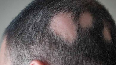 T cells regrow hair in alopecia areata