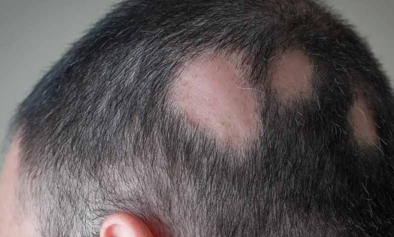 T cells regrow hair in alopecia areata