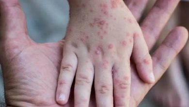 Monkeypox - More than 5,000 confirmed cases worldwide