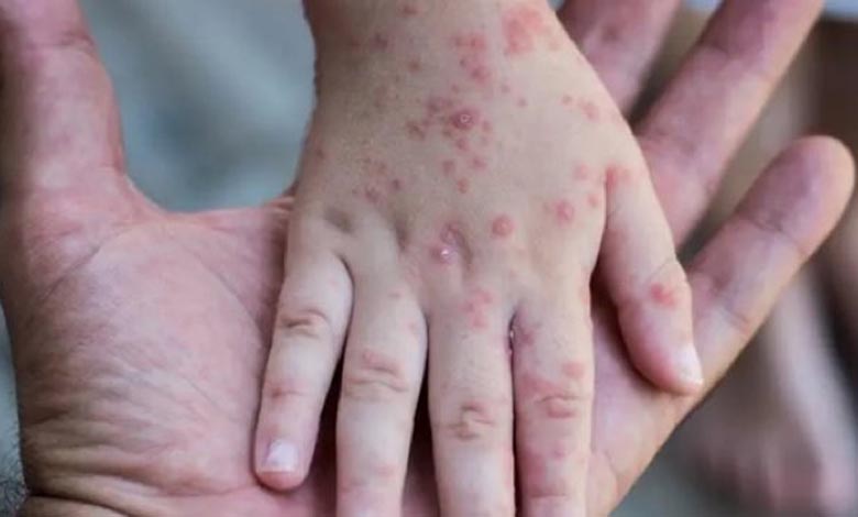 Monkeypox - More than 5,000 confirmed cases worldwide