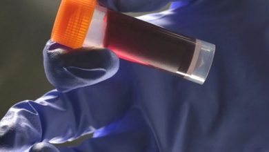 Study - Blood type influences stroke risk