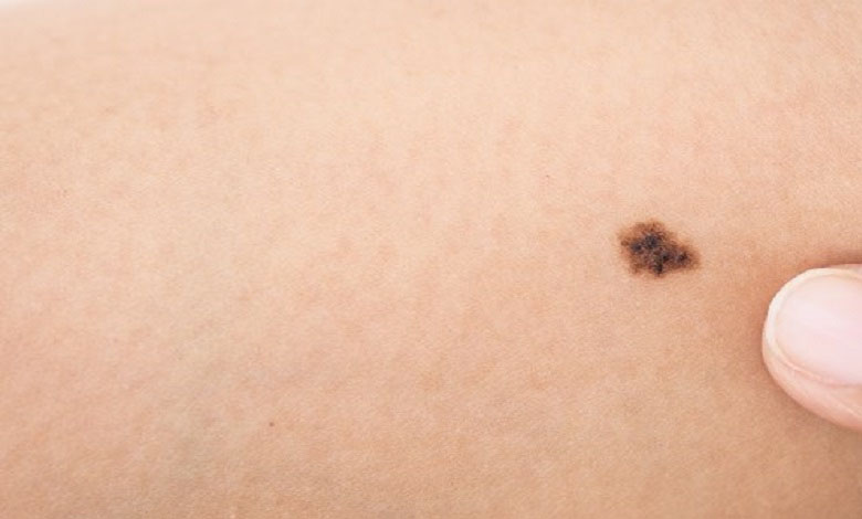 Melanoma diet - Check out the most serious type 