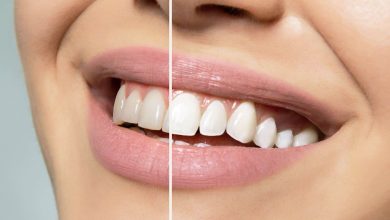 Expert-recommended methods for teeth whitening