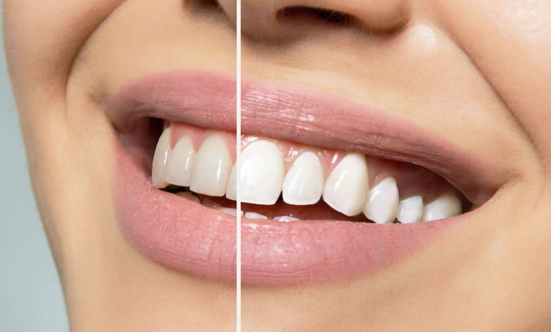 Expert-recommended methods for teeth whitening