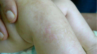 Incontinentia Pigmenti - symptoms, diagnosis, treatment of this genetic disease