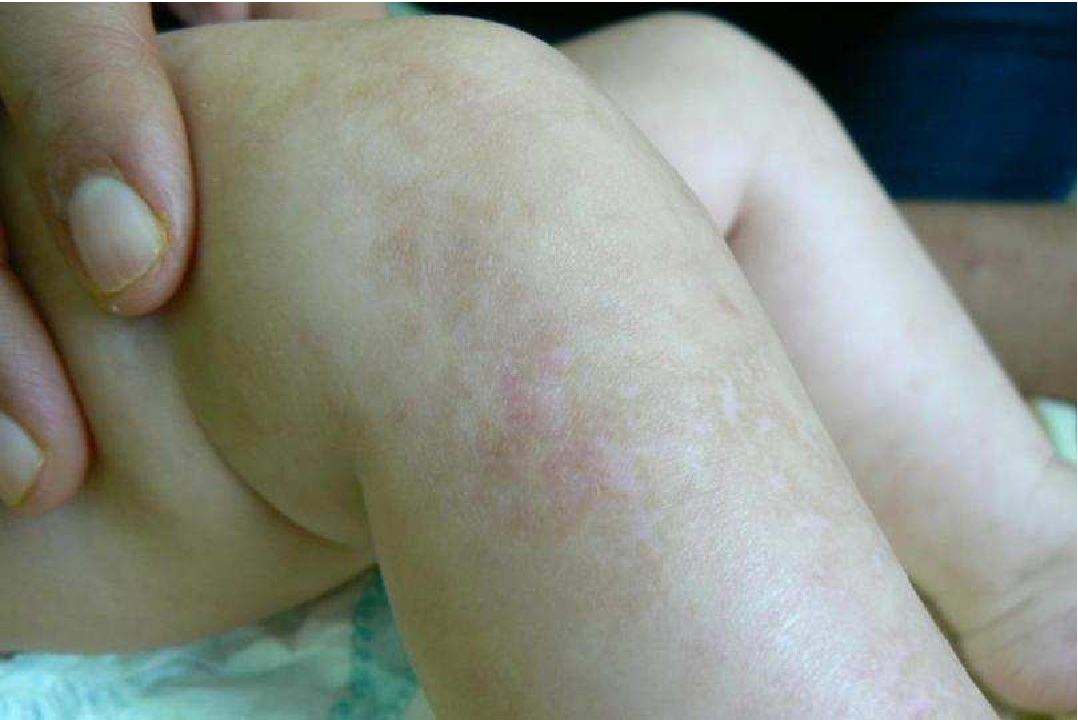 Incontinentia Pigmenti symptoms, diagnosis, treatment of this disease En.ImArabic
