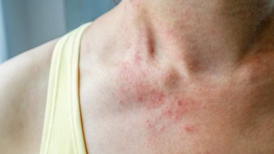 Allergy to dust- how to recognize symptoms?