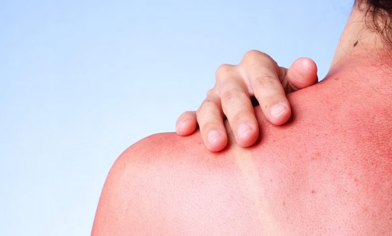 How long does a sun allergy last?