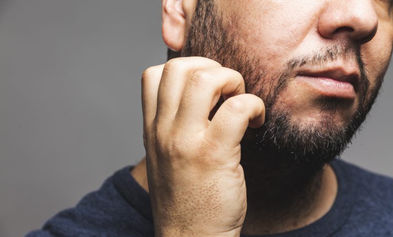 Itching beard: six possible causes