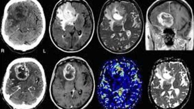 Development of a test to detect brain cancer... The First and Fastest in the World 