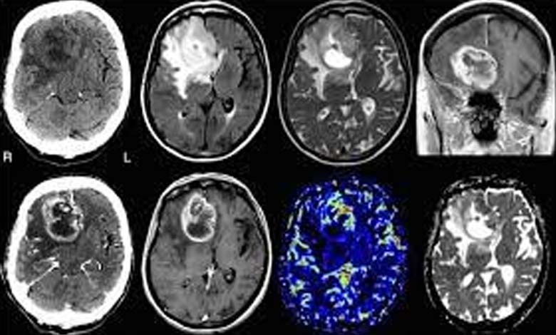 Development of a test to detect brain cancer... The First and Fastest in the World 