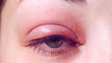 Eye swelling in winter... How to deal with it?