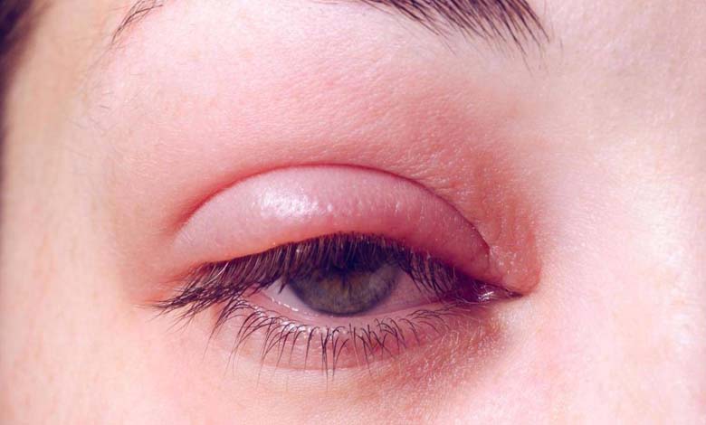 Eye swelling in winter... How to deal with it?