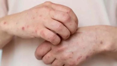 Scabies outbreak raises concern in the United Kingdom 