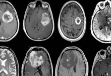 Neurological Diseases Cause Increased Mortality Rates Among Young People