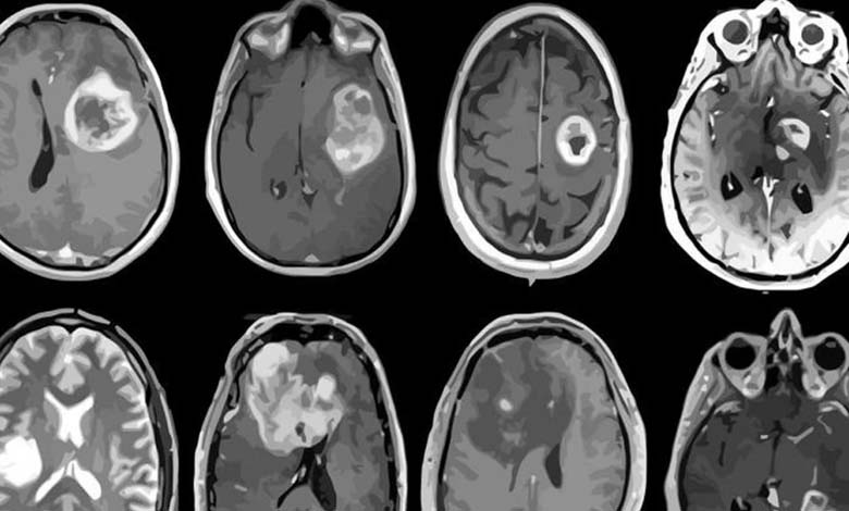 Neurological Diseases Cause Increased Mortality Rates Among Young People
