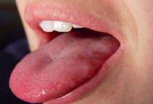 The Color of Your Tongue Can Reveal Your Health Condition
