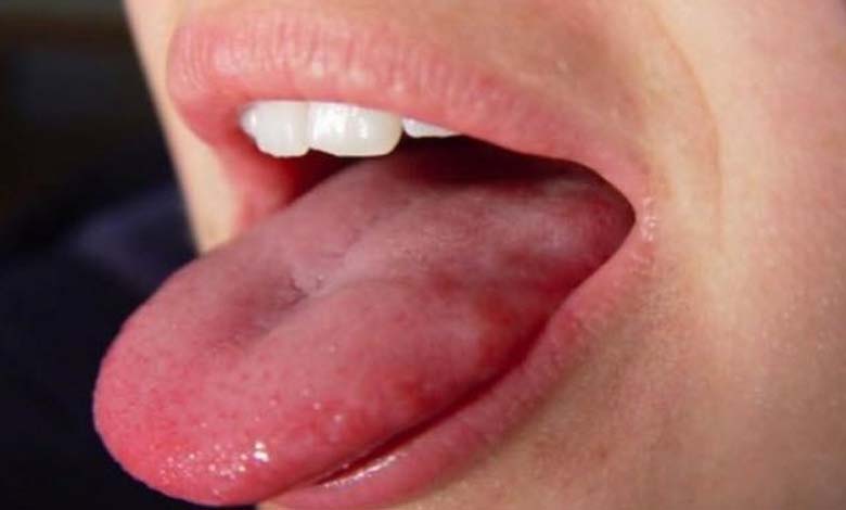 The Color of Your Tongue Can Reveal Your Health Condition