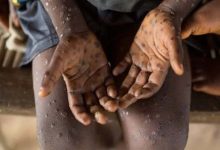 Nigeria announces an increase in "monkeypox" cases to 48