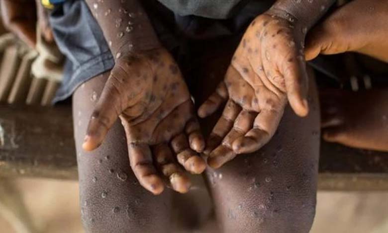 Nigeria announces an increase in "monkeypox" cases to 48