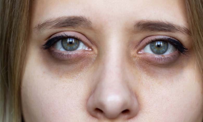 One Cause is Dehydration... Reasons Behind Dark Circles Around the Eyes