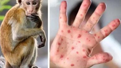 Sweden Detects First Case of Monkeypox