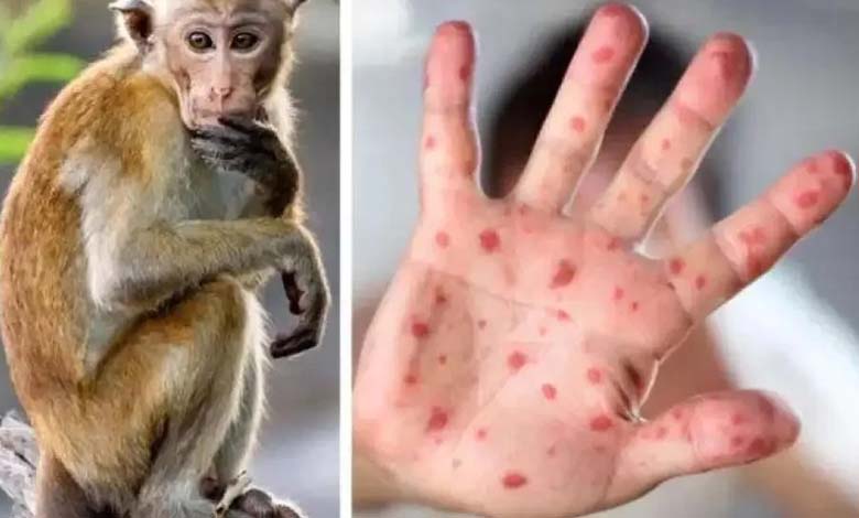 Sweden Detects First Case of Monkeypox