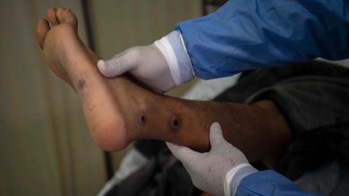 Vaccine Shortages Hinder Africa's Efforts to Combat "Monkeypox"