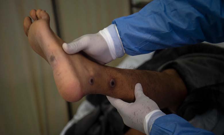 Vaccine Shortages Hinder Africa's Efforts to Combat "Monkeypox"