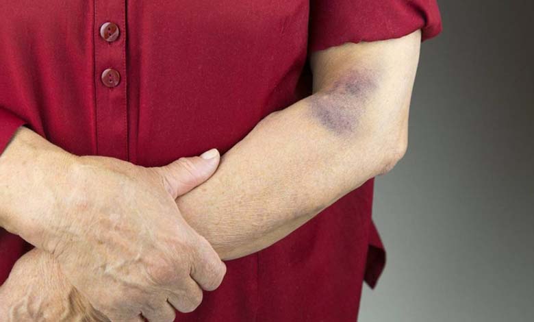 Causes of Bruising in Elderly People