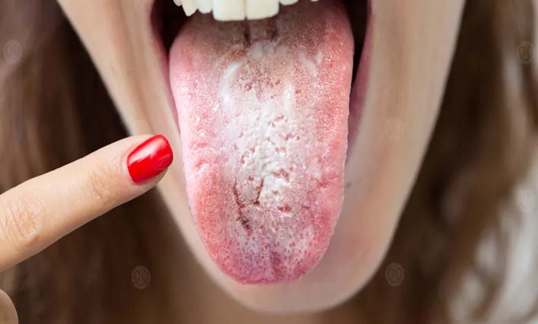 How Can Oral Bacteria Cause Cancer?