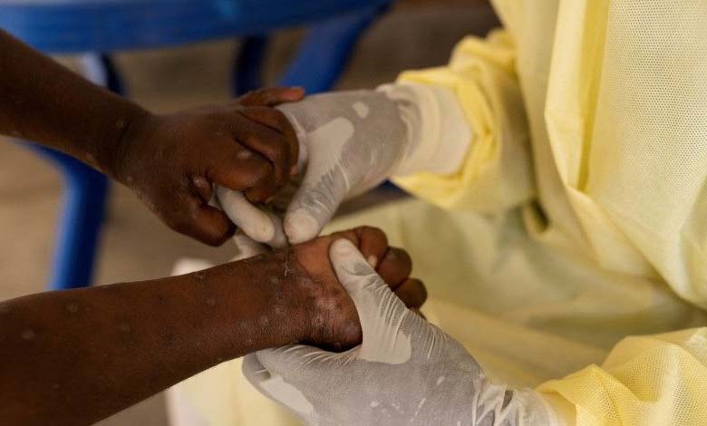 Zambia Reports Its First Case of Monkeypox