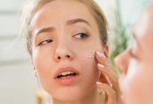 With Winter Approaching… 5 Tips for Treating Dry Skin