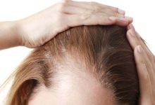 Surprising Discovery for Treating Hair Loss and Genetic Baldness