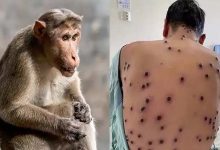 France Records First Monkeypox Case