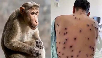 France Records First Monkeypox Case