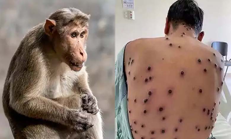 France Records First Monkeypox Case