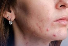 Study Reveals a Troubling Link Between Acne and Eating Disorders