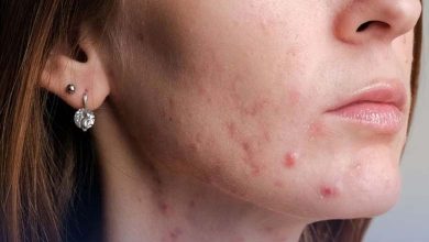 Study Reveals a Troubling Link Between Acne and Eating Disorders
