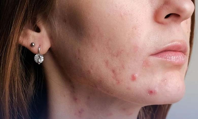 Study Reveals a Troubling Link Between Acne and Eating Disorders