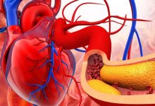 3 Symptoms That May Reveal Coronary Artery Blockage