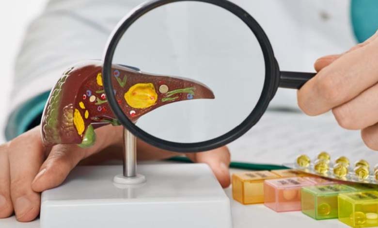 How to Prevent Recurring Gallbladder Inflammation (Cholecystitis)