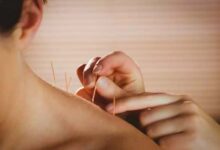Acupuncture: Effective Results or Mere Hype?