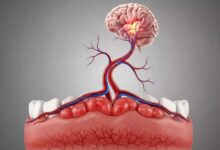 Gum Diseases: A Risk Factor for White Matter Damage in the Brain