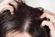 How does zinc help fight dandruff?